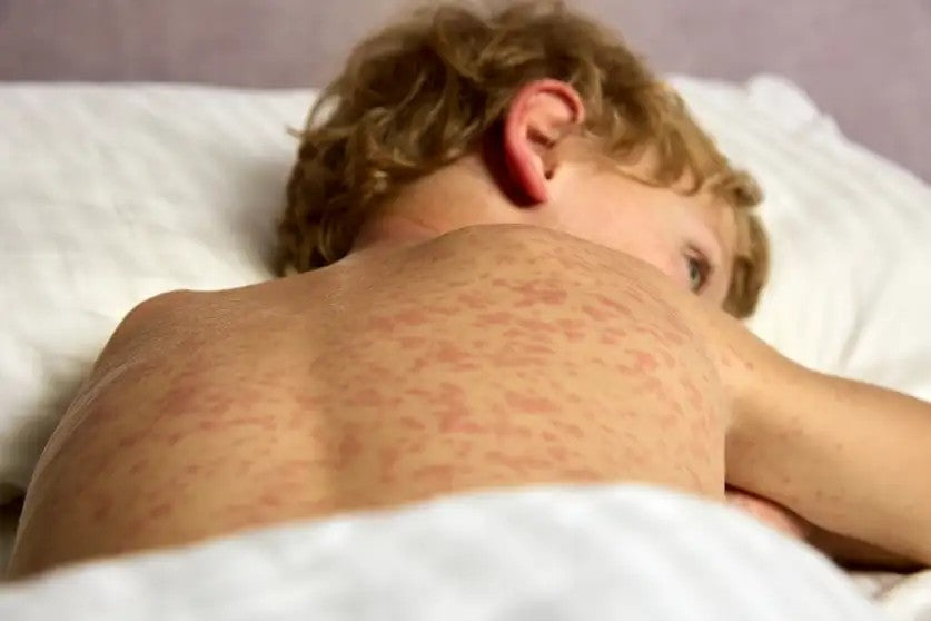 Health Topic: Measles — What You Need to Know About This Resurging Disease